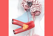 How to prevent stroke that hit actor Mithun Chakraborty