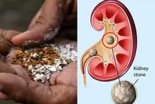 Pan masala can cause larger kidney stones: Experts