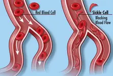 World Sickle Cell Day: Gujarat screens over 17 lakh in last five years