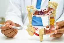 Late diagnosis of appendix cancer a concern, say experts