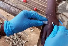 WHO declares global health emergency over Mpox outbreak