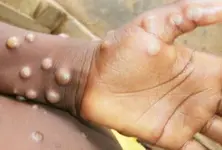Sweden reports 1st case of more infectious mpox variant outside Africa