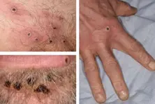 Suspected Mpox case under investigation, patient isolated: Centre