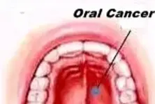 Smokeless tobacco, betel nut drive oral cancer cases in India, highest in South Asia: Lancet