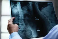 Spine-related problems due to stress on rise in Ahmedabad