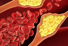 Covid infection spiked high cholesterol risk by 30%: Study