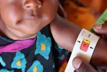 ₹509 cr spent on ‘Malnutrition Free Gujarat’, yet 5.40 lakh children malnourished