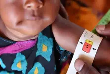 Malnutrition in Gujarat 37 per cent children stunted 20 per cent underweight