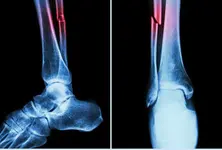 China develops injectable ‘bone glue’ for rapid fracture repair