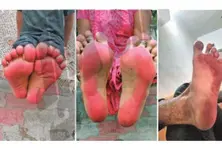 Naroda residents suffer red stained feet due to suspected airborne chemical pollution