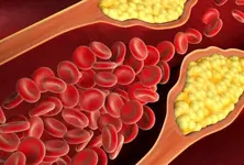 Scientists edit gene that could permanently lower high cholesterol