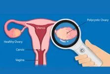 PCOS renamed as PMOS to improve diagnosis and treatment