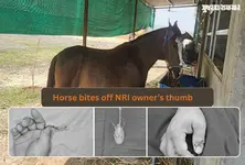 Horse bites off NRI owner’s thumb in Surat, doctors successfully reattach it