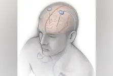 Brain stimulation shows promise for patients with severe OCD, study finds